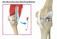 ACL Reconstruction Hamstring Tendon